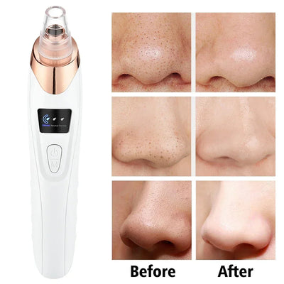 Blackhead remover,5-in-1 derma suction, pimple acne blackhead remover